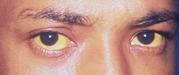 Eyes with yellow sclera