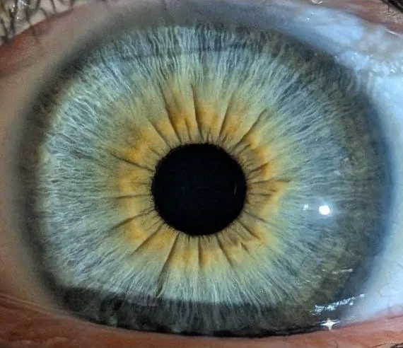Close-up blue iris photograph used for an IBS and antibiotic use example