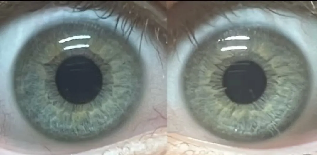 Pair of iris photographs used for a smoking history example