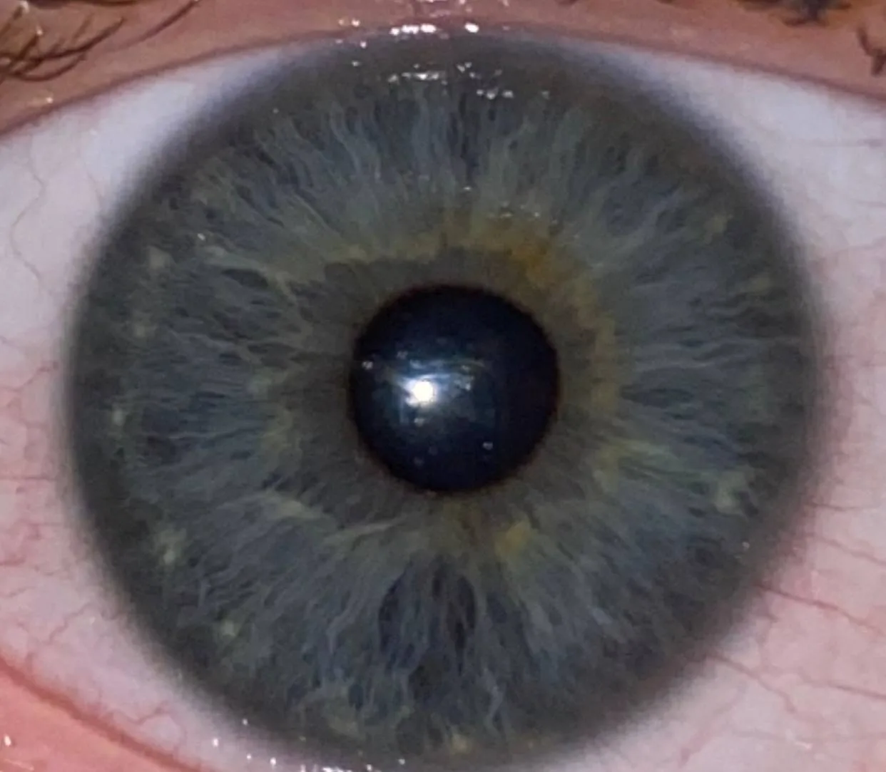 Close-up iris photograph from a Primal Diet group athlete with leg area degeneration at the bottom